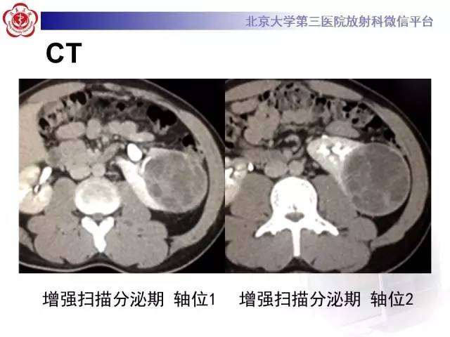 【病例】左肾上皮样血管平滑肌脂肪瘤1例CT及MR
