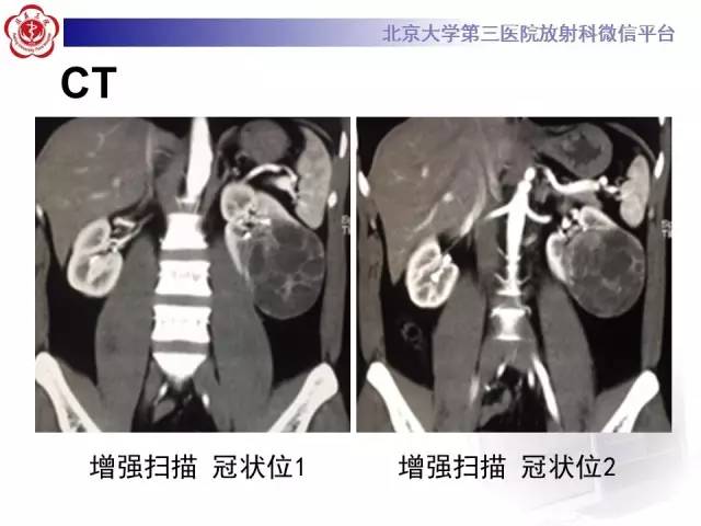 【病例】左肾上皮样血管平滑肌脂肪瘤1例CT及MR