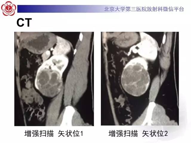 【病例】左肾上皮样血管平滑肌脂肪瘤1例CT及MR
