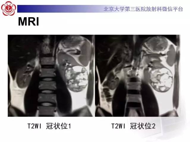 【病例】左肾上皮样血管平滑肌脂肪瘤1例CT及MR