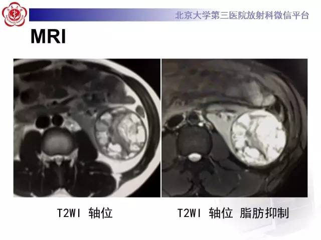 【病例】左肾上皮样血管平滑肌脂肪瘤1例CT及MR