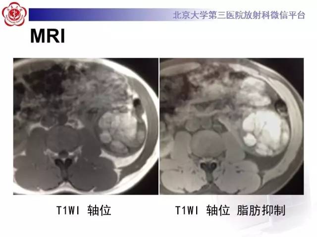 【病例】左肾上皮样血管平滑肌脂肪瘤1例CT及MR