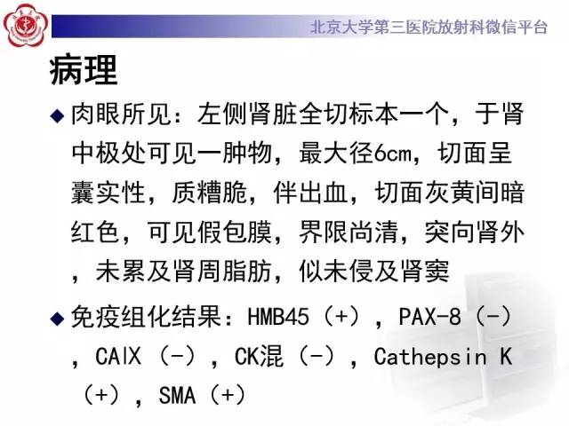 【病例】左肾上皮样血管平滑肌脂肪瘤1例CT及MR