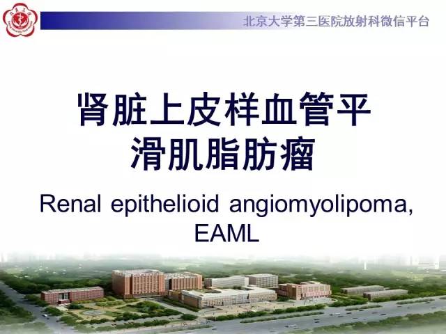 【病例】左肾上皮样血管平滑肌脂肪瘤1例CT及MR