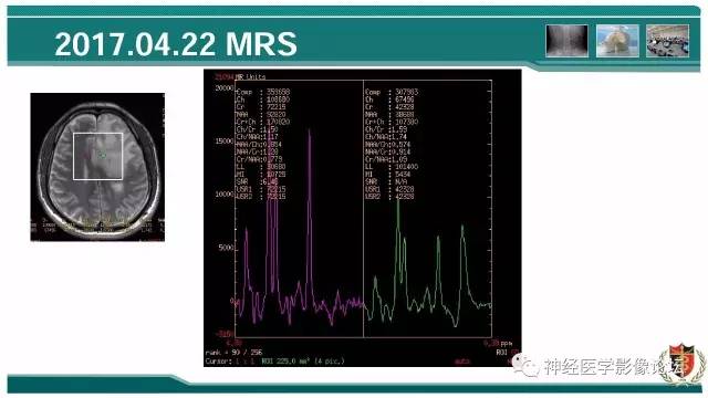 【病例】难得一见的IgG4脑炎MR