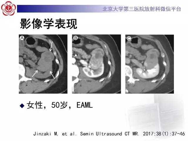【病例】左肾上皮样血管平滑肌脂肪瘤1例CT及MR