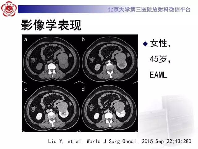 【病例】左肾上皮样血管平滑肌脂肪瘤1例CT及MR