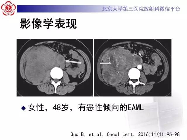 【病例】左肾上皮样血管平滑肌脂肪瘤1例CT及MR