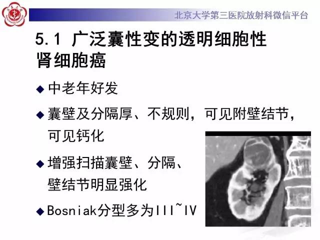 【病例】左肾上皮样血管平滑肌脂肪瘤1例CT及MR