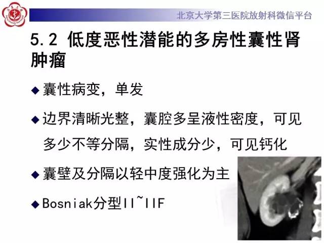 【病例】左肾上皮样血管平滑肌脂肪瘤1例CT及MR