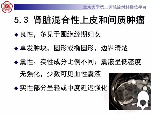 【病例】左肾上皮样血管平滑肌脂肪瘤1例CT及MR