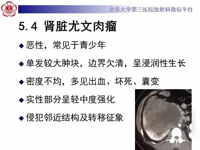 【病例】左肾上皮样血管平滑肌脂肪瘤1例CT及MR