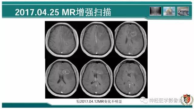 【病例】难得一见的IgG4脑炎MR