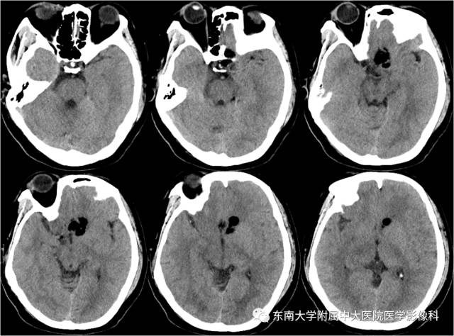 【病例】颅内畸胎瘤破裂1例CT及MR