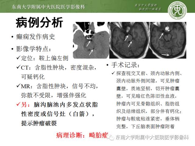 【病例】颅内畸胎瘤破裂1例CT及MR