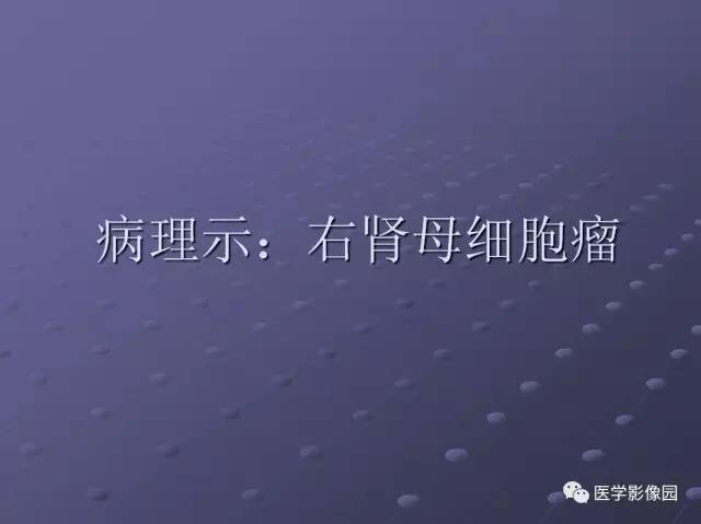 【病例】肾母细胞瘤1例CT影像表现