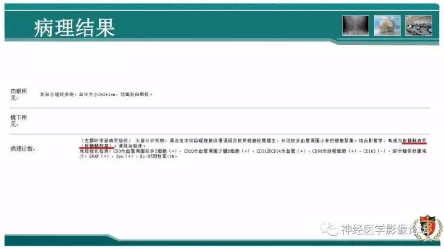 【病例】难得一见的IgG4脑炎MR