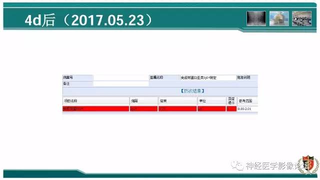 【病例】难得一见的IgG4脑炎MR