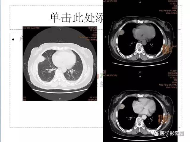 【病例】肺部炎性假瘤1例CT影像表现