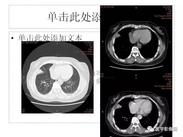 【病例】肺部炎性假瘤1例CT影像表现