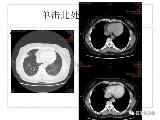 【病例】肺部炎性假瘤1例CT影像表现