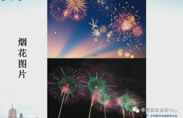 【PPT】肺部“烟花征”的影像表现与鉴别