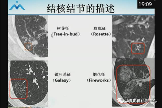 【PPT】肺部“烟花征”的影像表现与鉴别
