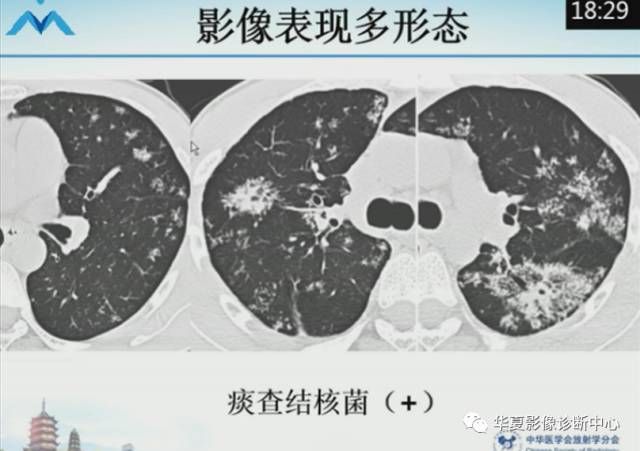 【PPT】肺部“烟花征”的影像表现与鉴别