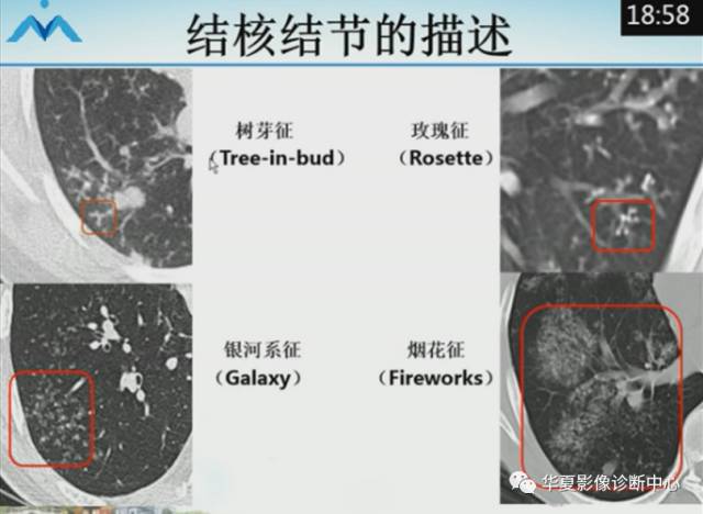 【PPT】肺部“烟花征”的影像表现与鉴别