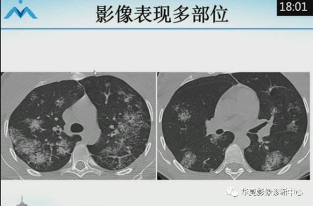 【PPT】肺部“烟花征”的影像表现与鉴别