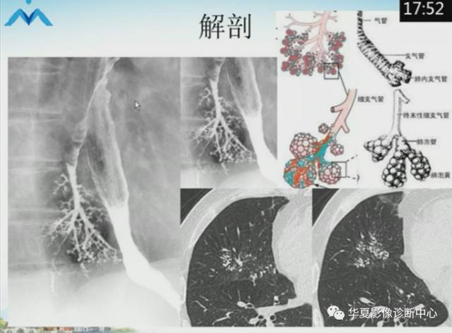 【PPT】肺部“烟花征”的影像表现与鉴别