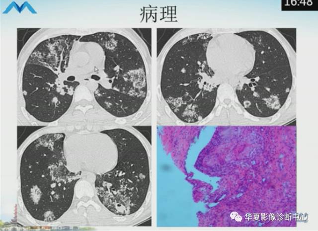 【PPT】肺部“烟花征”的影像表现与鉴别