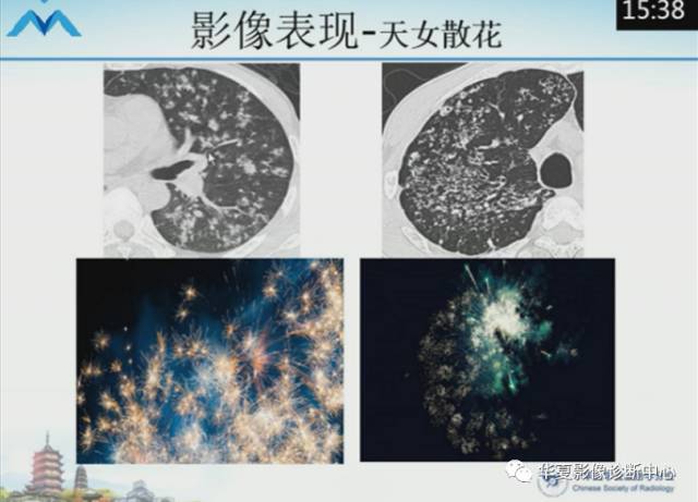 【PPT】肺部“烟花征”的影像表现与鉴别