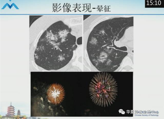 【PPT】肺部“烟花征”的影像表现与鉴别