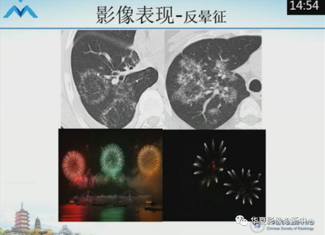 【PPT】肺部“烟花征”的影像表现与鉴别