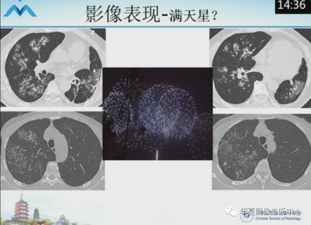 【PPT】肺部“烟花征”的影像表现与鉴别