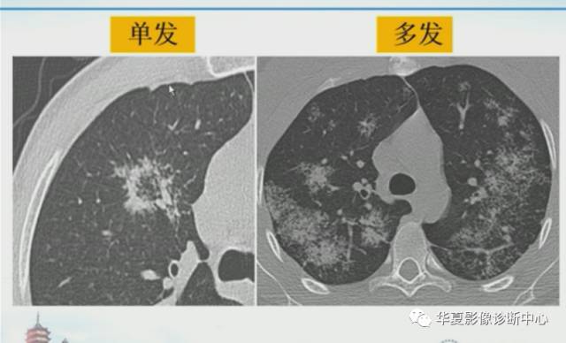 【PPT】肺部“烟花征”的影像表现与鉴别