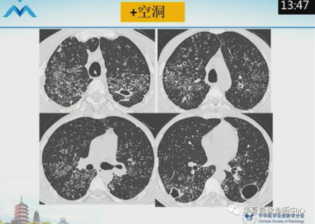 【PPT】肺部“烟花征”的影像表现与鉴别