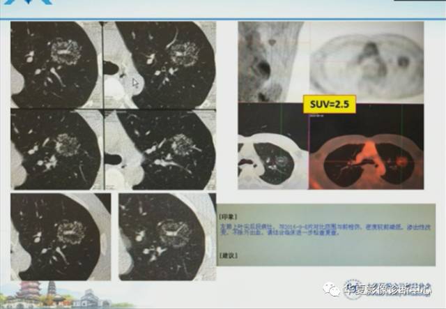 【PPT】肺部“烟花征”的影像表现与鉴别