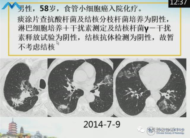 【PPT】肺部“烟花征”的影像表现与鉴别