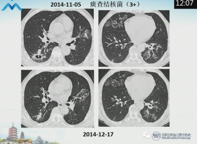 【PPT】肺部“烟花征”的影像表现与鉴别