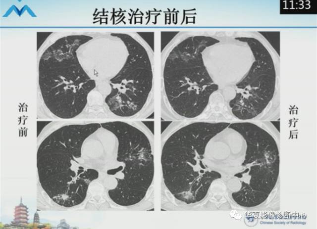 【PPT】肺部“烟花征”的影像表现与鉴别