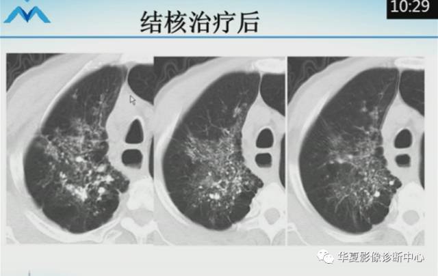 【PPT】肺部“烟花征”的影像表现与鉴别