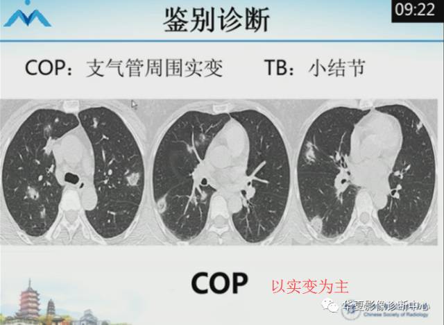 【PPT】肺部“烟花征”的影像表现与鉴别