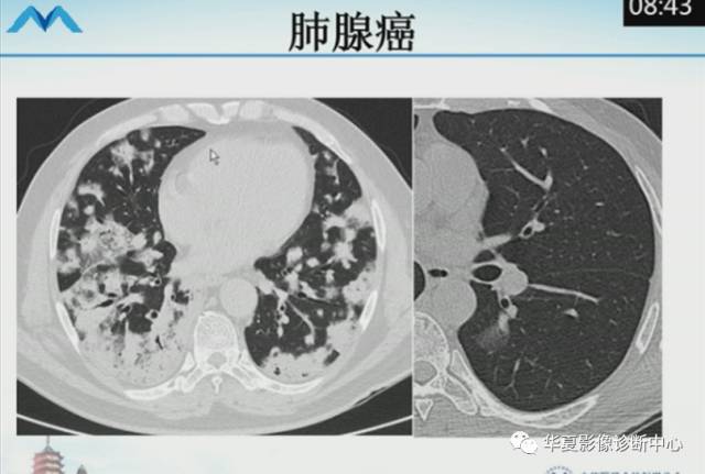 【PPT】肺部“烟花征”的影像表现与鉴别