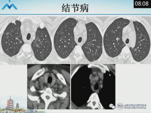 【PPT】肺部“烟花征”的影像表现与鉴别