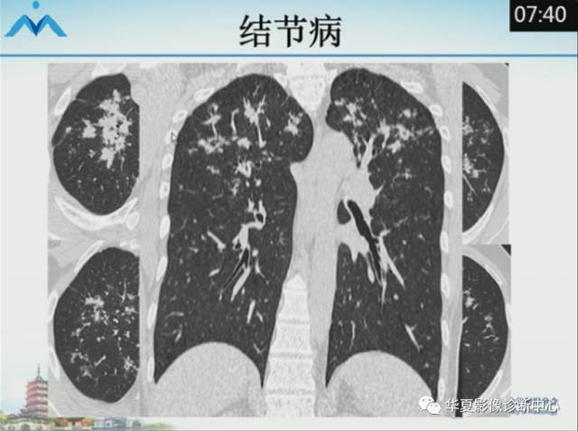 【PPT】肺部“烟花征”的影像表现与鉴别
