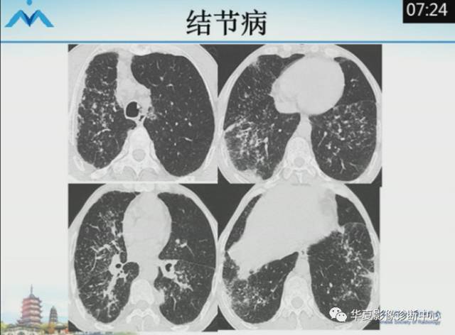【PPT】肺部“烟花征”的影像表现与鉴别