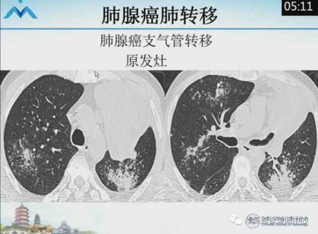 【PPT】肺部“烟花征”的影像表现与鉴别