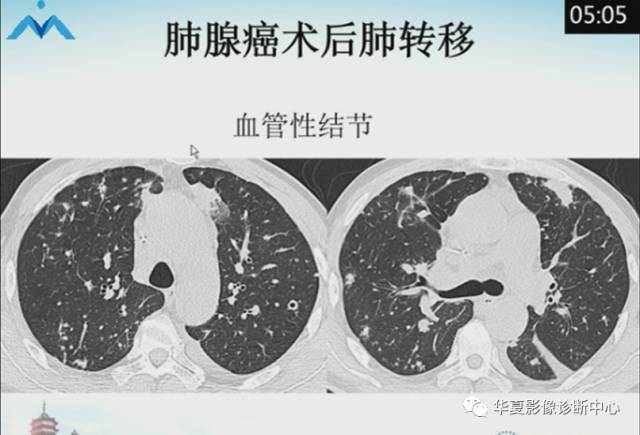 【PPT】肺部“烟花征”的影像表现与鉴别